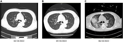 Case report: A rare case of death due to end-stage renal disease caused by Tripterygium wilfordii-induced myelosuppression